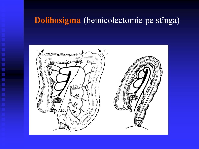 Dolihosigma (hemicolectomie pe stînga)